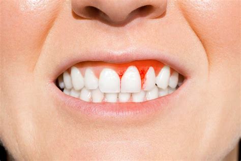 Are Your Gums Bleeding When You Brush Your Teeth