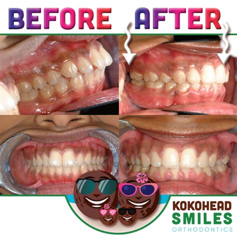 Best Orthodontist Honolulu Hi Before After Invisalign Braces