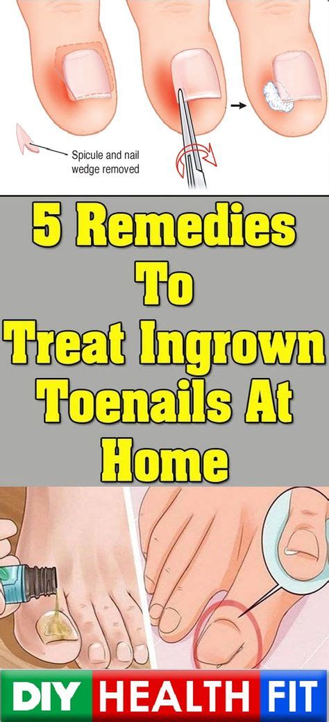 5 Remedies To Treat Ingrown Toenails At Home Treating Ingrown Ingrown Nail Ingrown Toe Nail