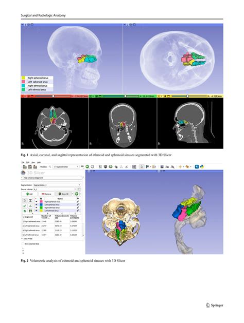 Pdf Analysis Of Sphenoid Sinus And Ethmoid Sinus Volume And Asymmetry