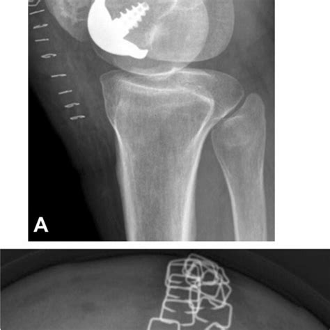 Anterior Posterior A And Lateral Standing B Radiographic Views