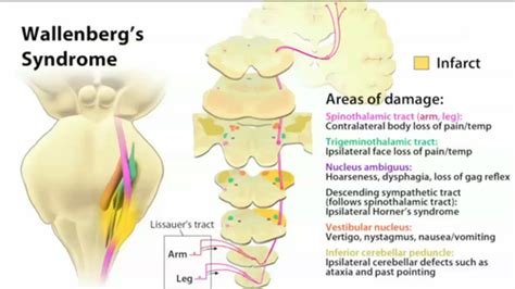 Pthr Ch And Lateral Medullary Pica Wallenburg S Syndrome