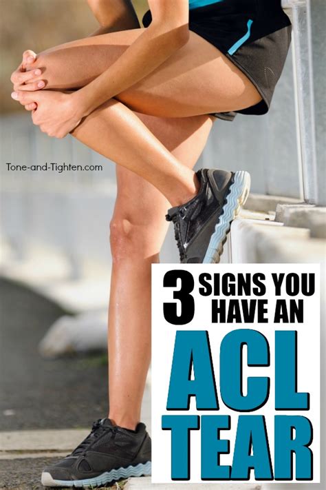 Visit Acl Sprain Physical Therapy Protocol Yonkers Ny