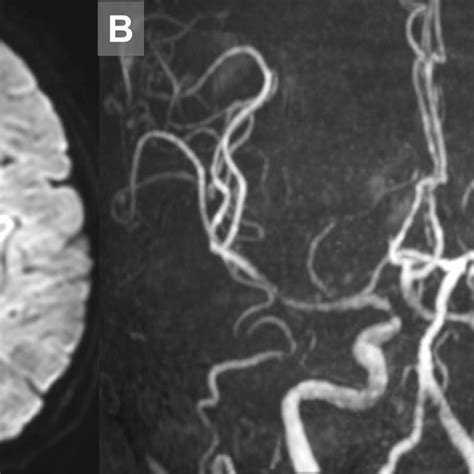 Postprocedural Image A And B Magnetic Resonance Imaging Performed On