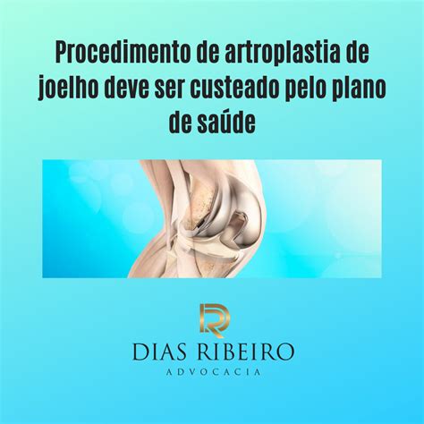 Arquivo De Artroplastia De Joelho Dias Ribeiro Advocacia