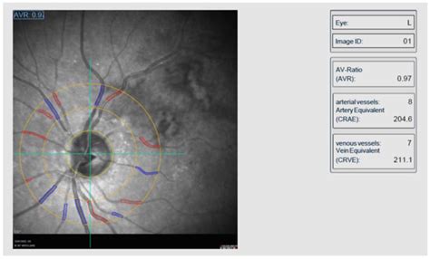 Jpm Free Full Text Alterations In Retinal Vessel Diameters In