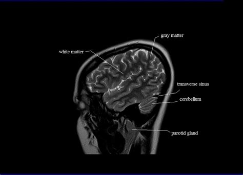 cross sectional anatomy mri brain sagittal anatomy  mri brain