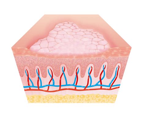 wound types | trigocare