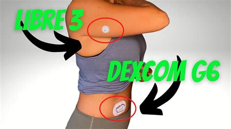 Dexcom G Or Freestyle Libre Which One Is Best Youtube