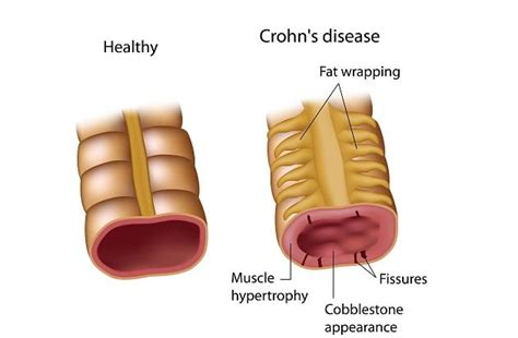 Crohn’s Disease: Causes, Symptoms, Diagnosis, Treatment - DiseaseFix