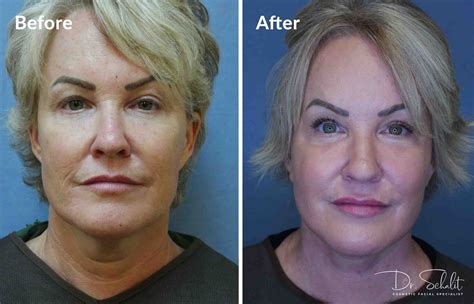 Face And Neck Lift Index Dr Schalit Cosmetic Facial Specialist