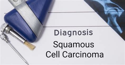 Squamous Cell Carcinoma: From Diagnosis to Prognosis - Facty Health