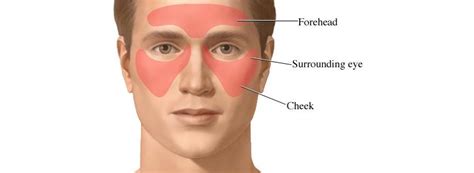 Sinus Infection - ENT Clinic