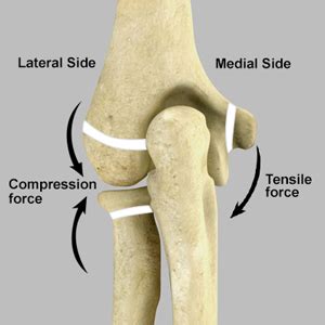 Little League Elbow - Academy Orthopedics