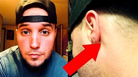 Lump Behind My Ear Has Grown Bigger Youtube