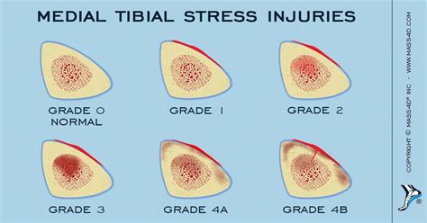 Grade 4 Stress Fracture