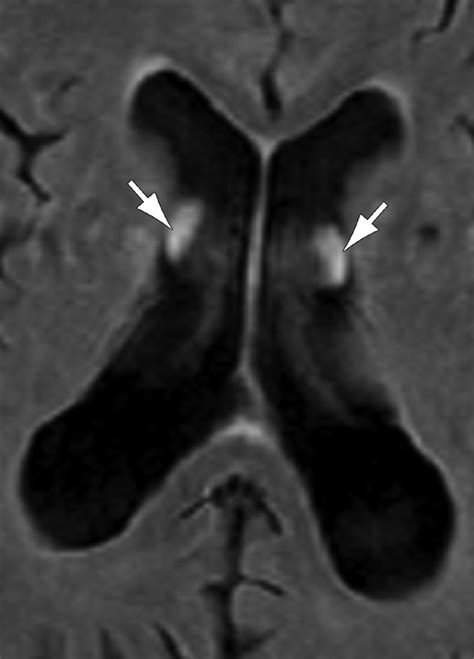 Normal Mri Appearance And Motion Related Phenomena Of Csf Ajr