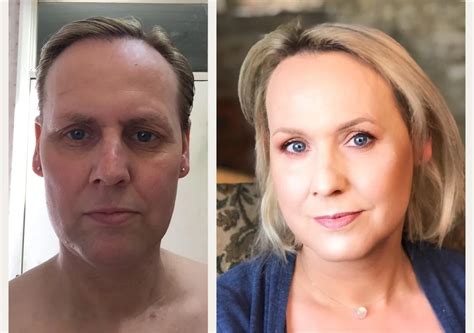 Pictures Of Post Op Male To Female Ncee