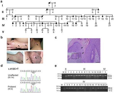 The Pedigree Tree Clinical Manifestations And Mutation Information Of