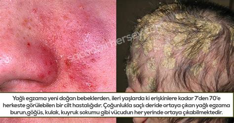 Ya L Egzama Seboreik Dermatit Neden Olur Belirtileri Ve Tedavisi