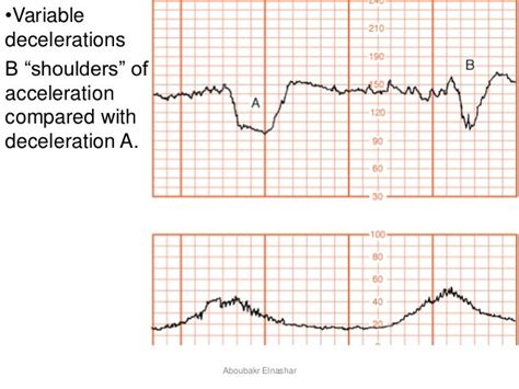 Cardiotocography Ctg Antepartum And Intrapartum