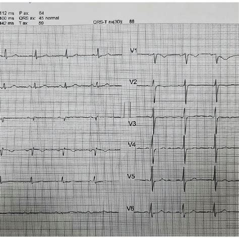 The patient’s ECG on admission showed flattening of the T-wave. ECG ...