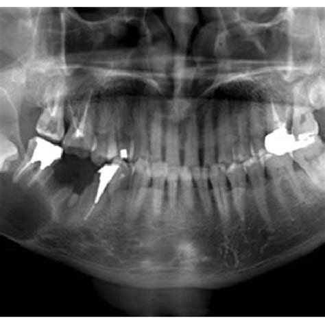 Panoramic Image Multilocular Lesion On Right Side Area Of Mandible