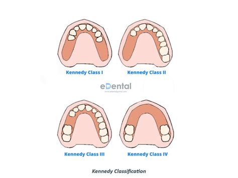 Kennedy Classification And Applegates Rules In Rpd Partial Dentures Dental Lab Technician