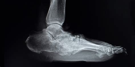 Charcot Foot