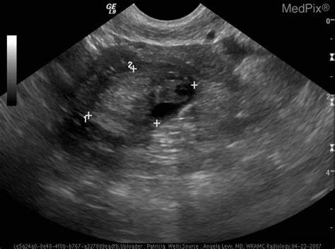 Dermoid Ovarian Cyst Ultrasound