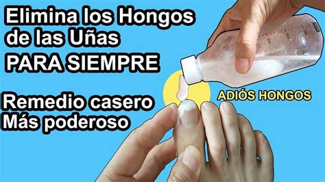 Esta Mezcla Elimina Los Hongos De Las U As De Los Pies Y De Las Manos