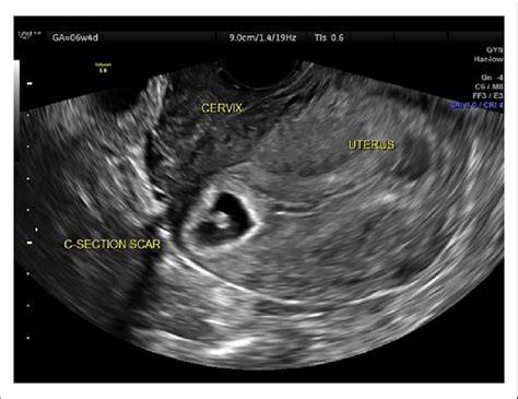 Transvaginal Sonography In Case Report 2 That Demonstrated A Cesarean