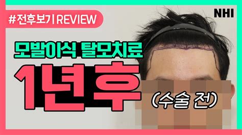 남자 헤어라인교정 모발이식 1년 후m자이마 앞머리 탈모시청 필수ㅣ전후보기reviewㅣ뉴헤어 Youtube