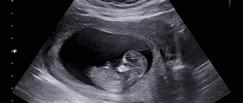 Ultrasound of a 12 weeks old fetus