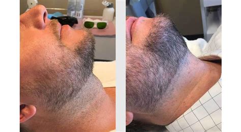 Laser Hair Removal For Men Seattle Plastic Surgery