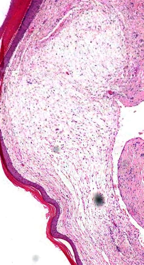 Pin On Dermatopathology Quiz Cases