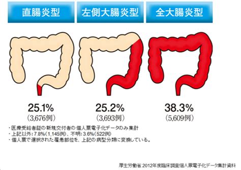 潰瘍性大腸炎（かいようせいだいちょうえん） きたがわ内科のりこ皮ふ科クリニックブログ