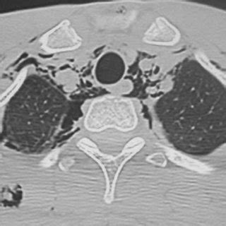 Barotrauma A 23 Year Old Man Presenting With Chest Pain And No History