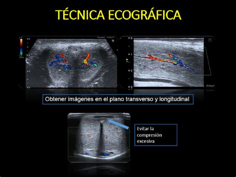 Figure 8 from ECOGRAFÍA DOPPLER PENEANA EN EL ESTUDIO DE LA DISFUNCIÓN