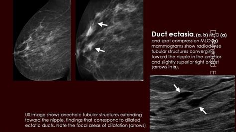 Breast Duct Ectasia Us Mammogram Mri