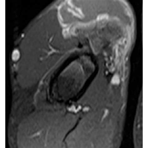 Axial T Weighted A T Weighted Fat Suppressed Precontrast B And