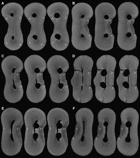 Micro CT Cross Section Slices From Six Mesial Roots Of Mandibular