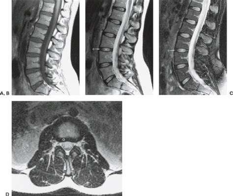 Degenerative Disease Of The Spine Radiology Key