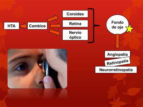 Retinopatía hipertensiva PPT