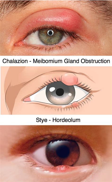 Antibiotic Eye Drops For Chalazion Edu Svet Gob Gt