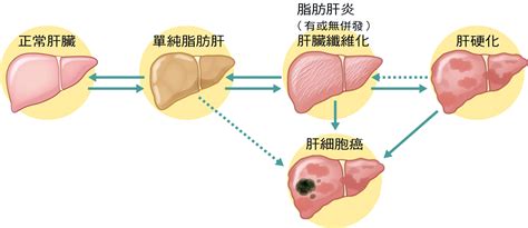 分院報導 基隆分院 非酒精性脂肪肝