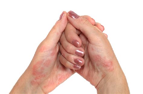 Psoriasi Dalla Patologia Cutanea Allartrite Psoriasica