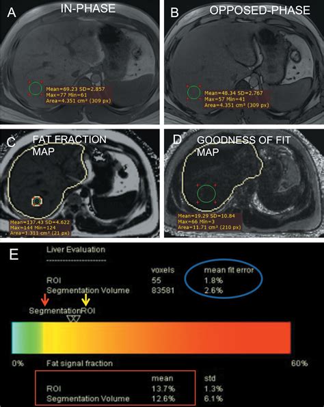 Scielo Brasil Non Invasive Hepatic Fat Quantification Can Multi