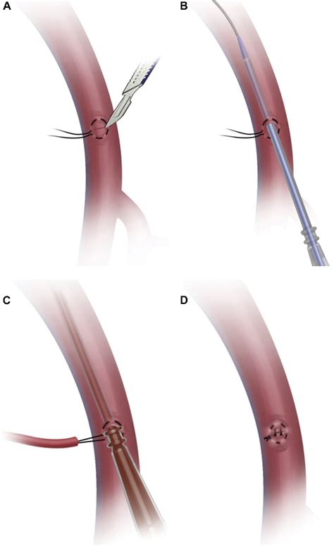 Figure From Open Seldinger Guided Femoral Artery Cannulation