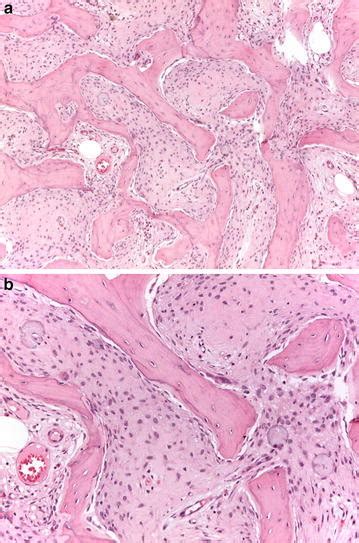 A low grade (grade 2) fibroblastic osteosarcoma, fibrous dysplasia-like ...